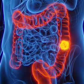 Robotic surgery is associated with improved outcomes for most colon cancer patients