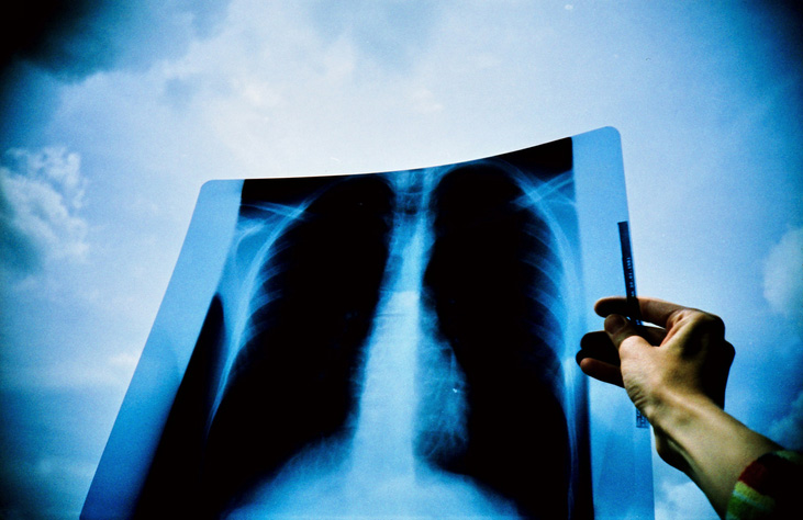 Study: Double-drug strategy blocks escape route for most lung cancers
