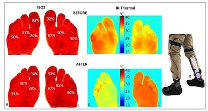 A sole mate to prevent diabetic foot ulcers