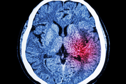 JAMA study: How stroke patients can best control blood sugar