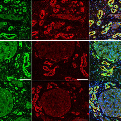 Study reveals biomarker for high risk of metastasis