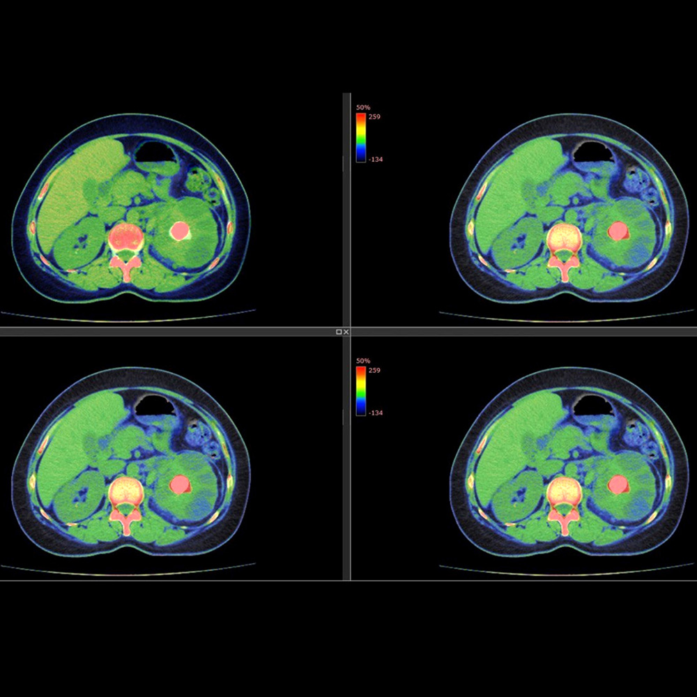 Lots Of Water Small Dietary Changes Can Help Prevent Kidney Stones 