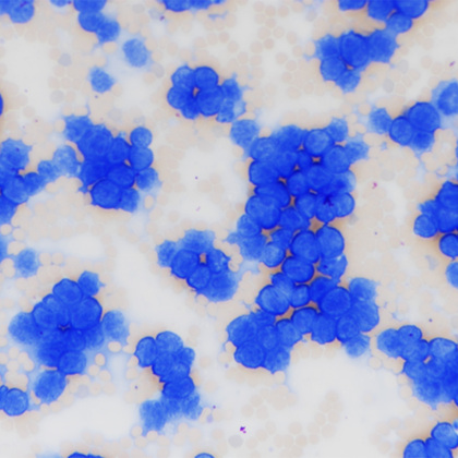 Targeting protein has potential to treat leukemia, lymphoma