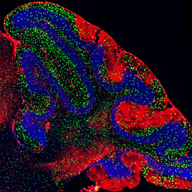 Researchers find immune component to rare neurodegenerative disease