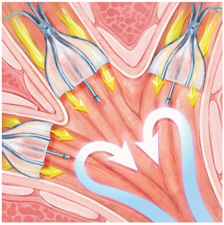 Photo of redirecting air in lungs