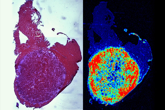 at left is a microscopic view of cancer (shown in purple) surrounded by normal tissue; at right the same cellular image has the cancer highlighted in neon colors on a dark background