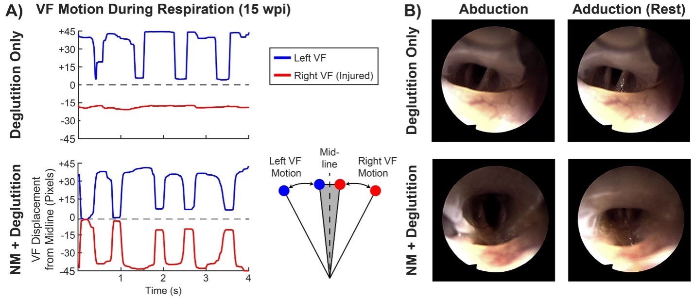 Sensory Mechanisms in Primary Muscle Tension Dysphonia: VF Motion During Respiration