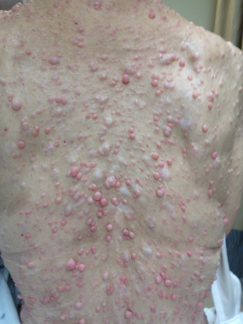 Cutaneous neurofibromas cover the back of a patient.