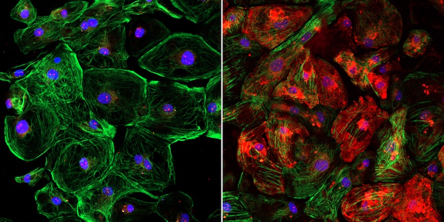 The images illustrate the lack of dystrophin, shown in red, in an unedited human heart muscle cell with DMD (left) and the restoration of dystrophin in a CRISPR-edited human heart muscle cell (right).