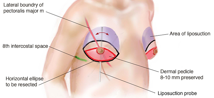 Illustration of a torso that area involved in breast reduction surgery