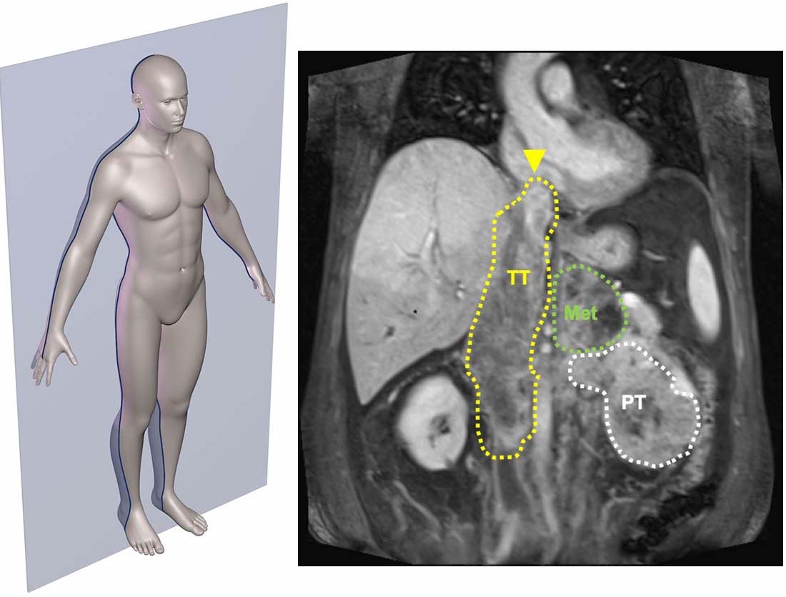 Unusual Kidney Cancer Feature Sheds Light Into How Cancers Invade And 