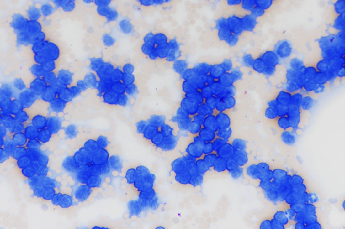 ZFP574 eliminates leukemic B cells (blue) over non-malignant B cells in vivo