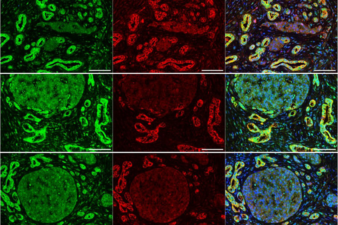 Co-localization of AKT3 (red) and the transcription factor Snail (green) in human pancreatic cancer