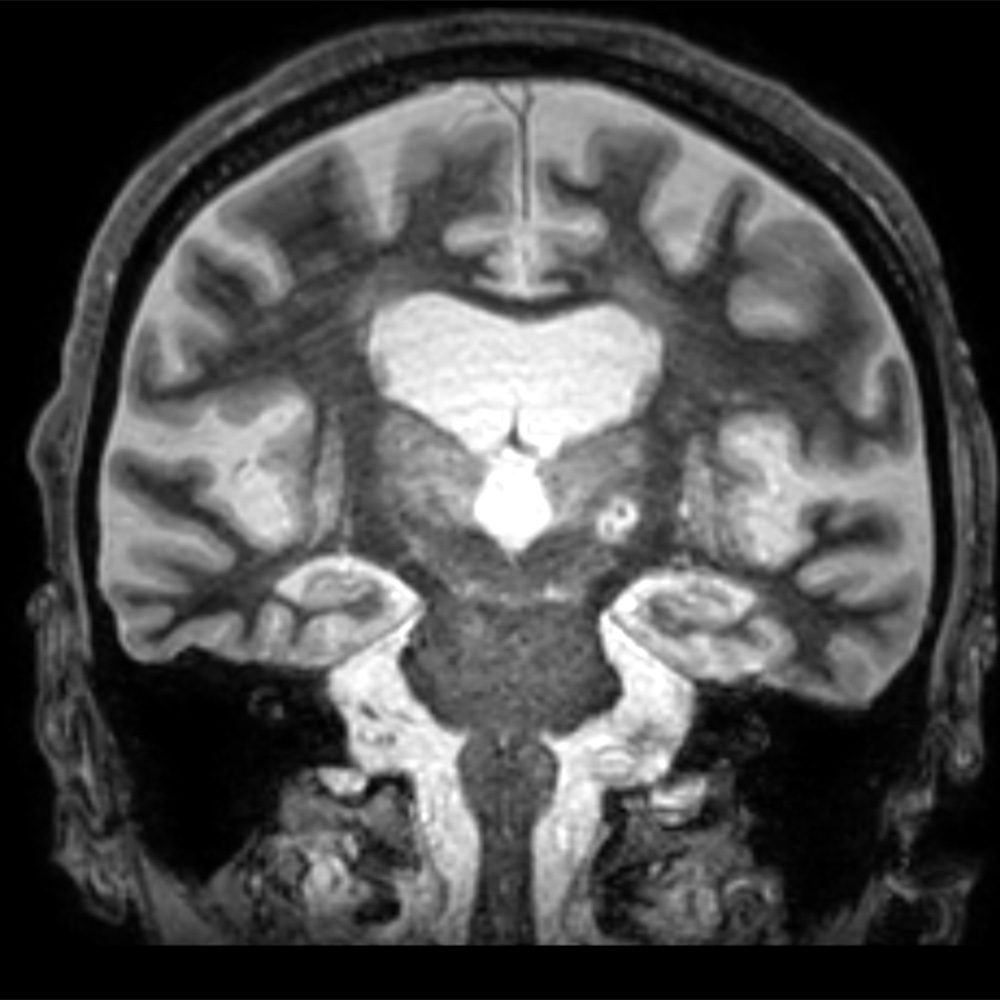 A coronal magnetic resonance imaging