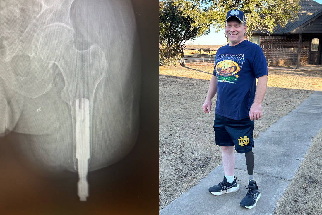 Scott Bryson is back on his feet after undergoing osseointegration surgery at UT Southwestern. The x-ray shows the titanium metal implant set in his leg bone to serve as the base for his prosthetic limb.